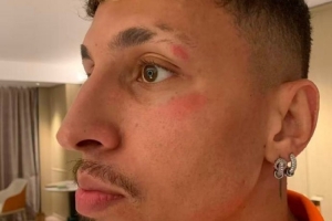 記者：克雷桑頭部被踢了一下，換下他是用了腦震蕩條款